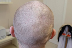 Проблема "высокого лба" после пересадки волос